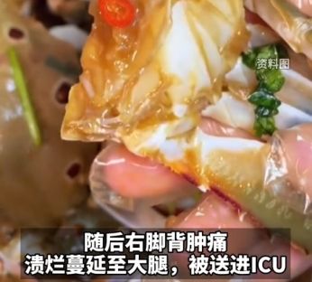 吃自制生腌蟹进ICU吃自制生腌蟹，进ICU的背后故事